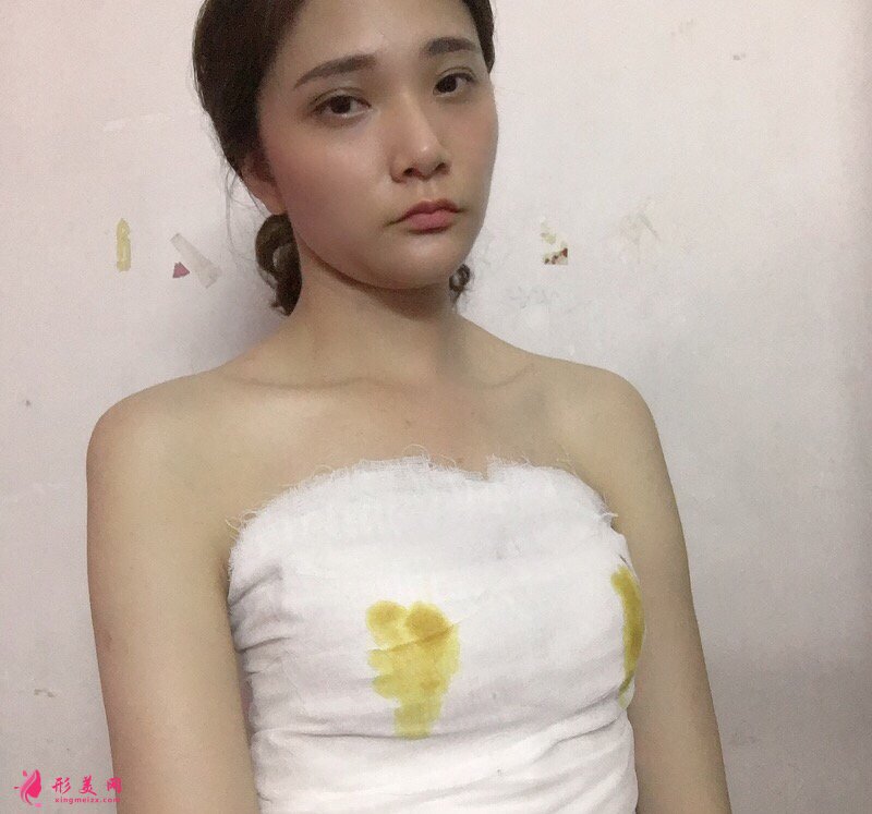 南京華美沈正宇醫(yī)師真人隆胸案例 50天前后對(duì)比圖分享