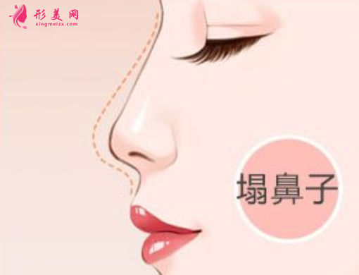 自體軟骨隆鼻效果怎么樣
