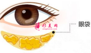 手術(shù)祛眼袋需不需拆線