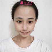武漢藝星醫(yī)療美容醫(yī)院小仙女眼部綜合術后恢復情況分享