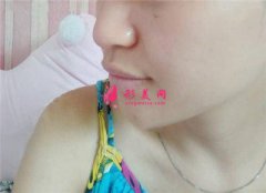 北京潤美玉之光假體隆鼻術后恢復情況對比