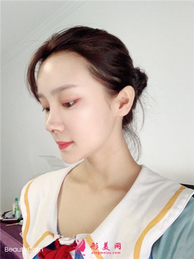 南昌假體隆鼻術(shù)后恢復(fù)情況對比