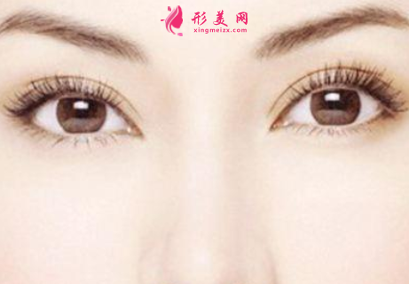 雙眼皮手術(shù)做了可以保持多久