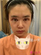 北京潤(rùn)美玉之光全切雙眼皮術(shù)后恢復(fù)情況對(duì)比圖分享