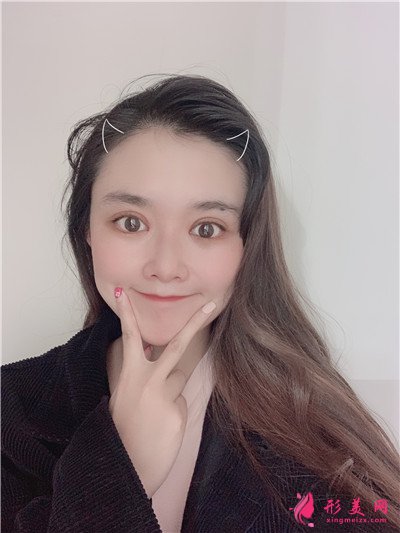 南寧全切雙眼皮術后恢復情況對比圖分享