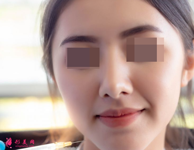 自體脂肪填充臉部多久恢復(fù)自然