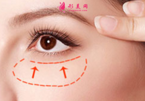 手術(shù)祛眼袋后可以化妝嗎