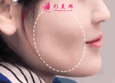 自體脂肪填充臉部一般要注射幾次