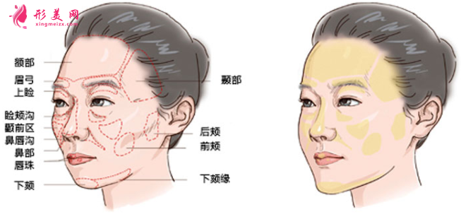 自體脂肪填充臉部要怎么做護理工作