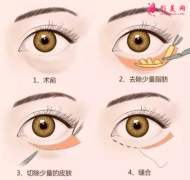 祛眼袋手術(shù)大概多少錢？