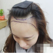 北京煤炭總醫(yī)院小姐姐發(fā)際線(xiàn)調(diào)整手術(shù)案例對(duì)比圖