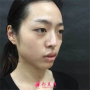南京華美美容醫(yī)院膨體隆鼻術后恢復效果分享