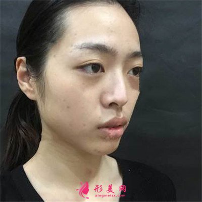南京膨體隆鼻術(shù)后恢復(fù)效果分享