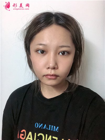杭州面部線雕術(shù)后恢復(fù)情況反饋