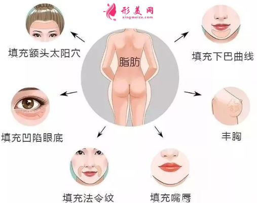 自體脂肪填充臉部吃什么可以加快消腫