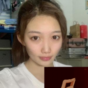 成都武侯蓉美和諧醫(yī)療美容做自體脂肪全臉填充怎么樣？