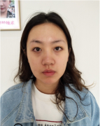 杭州華山連天美醫(yī)療美容醫(yī)院吸脂怎么樣？附面部吸脂案例