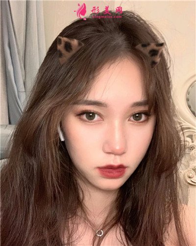 杭州小仙女全切雙眼皮手術(shù)術(shù)后效果分享