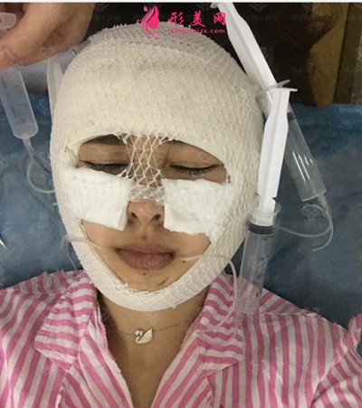 成都吸脂瘦臉術(shù)后效果對比，小姐姐的臉型好看了很多