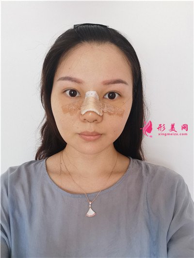 廣州小姐姐鼻綜合手術(shù)術(shù)后效果展示
