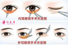 上海祛眼袋手術(shù)哪里做得比較好