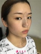 重慶聯(lián)合麗格美容醫(yī)院小仙女膨體隆鼻術(shù)后恢復(fù)情況展示