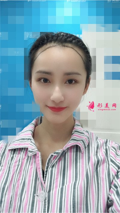 武漢發(fā)際線種植手術術后恢復效果分享