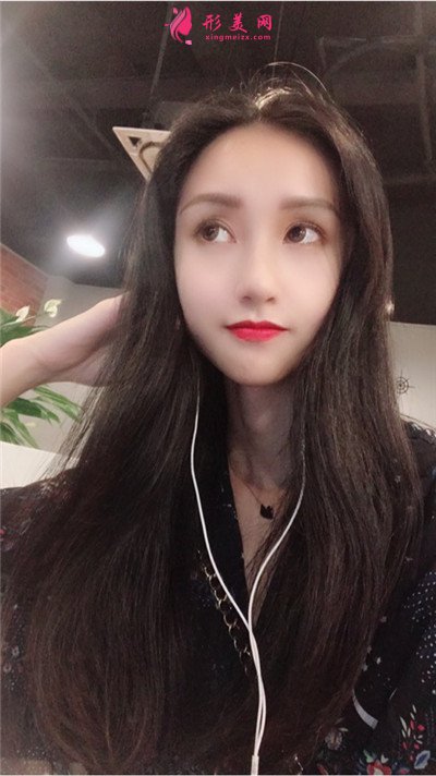 武漢發(fā)際線種植手術術后恢復效果分享