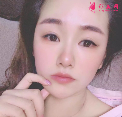 長(zhǎng)虹醫(yī)療分享光子嫩膚真實(shí)案例 術(shù)后94天效果圖