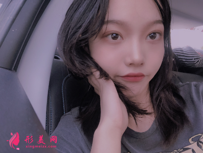 洛陽維美陳海濤做的雙眼皮 95天后效果真的很好