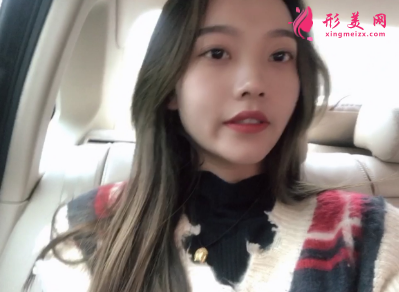 洛陽維美陳海濤做的雙眼皮 95天后效果真的很好