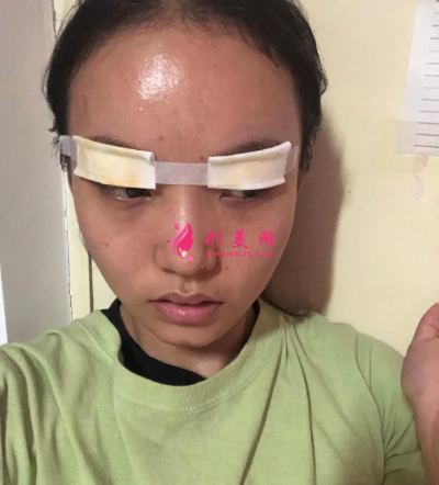 洛陽維美陳海濤做的雙眼皮 95天后效果真的很好