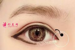 開(kāi)眼角出現(xiàn)明顯疤痕的原因