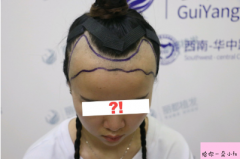 貴陽麗都植發(fā)醫(yī)院種植發(fā)際線怎么樣？附植發(fā)價格表一覽