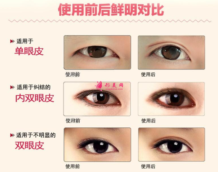 雙眼皮貼效果圖