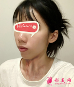 蘇州疤痕修復(fù)，愛思特醫(yī)院激光疤痕修復(fù)案例，疤痕不見了
