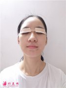 鄭州大學第二附屬醫(yī)院全切雙眼皮手術術后效果分享