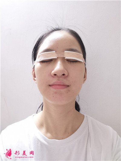 廈門全切雙眼皮手術(shù)術(shù)后效果分享