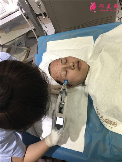 北京水光針治療術后效果對比分析