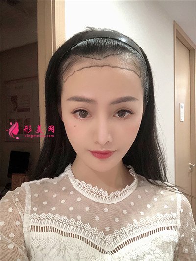 廣州小姐姐發(fā)際線種植手術(shù)術(shù)后效果反饋