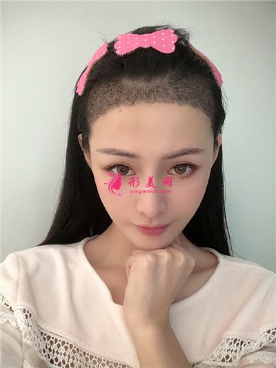 廣州小姐姐發(fā)際線種植手術(shù)術(shù)后效果反饋