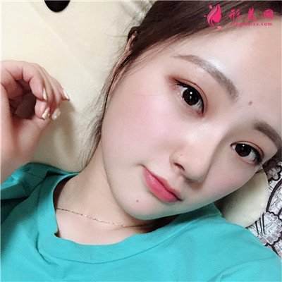 南昌眼部綜合手術(shù)術(shù)后效果反饋