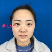 鄭州締萊美眼部綜合手術(shù)術(shù)后效果反饋