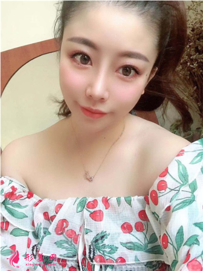 成都鼻綜合手術(shù)術(shù)后恢復(fù)情況對(duì)比