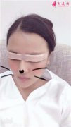 上海伊萊美小姐姐全切雙眼皮手術(shù)術(shù)后恢復(fù)情況對比