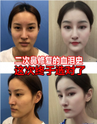 上海九院王濤隆鼻修復(fù)案例！告別鼻背透光問題