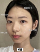 上海九院做面部填充效果好不好？花了不到2萬高顴骨不見了