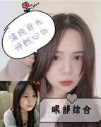 鄭州締萊美怎么樣？雙眼皮案例，徹底解決腫泡眼