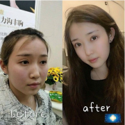 北京京民整形外科的雙眼皮修復(fù)案例，素顏化妝都很自然哦