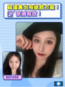 上海華美醫(yī)療美容醫(yī)院鼻綜合案例，塌鼻子的拯救方案